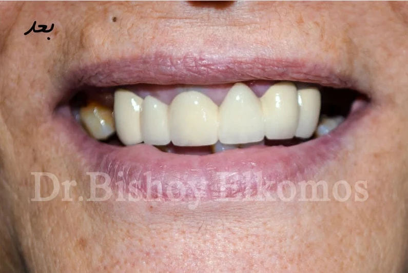 Front teeth after fixed crowns