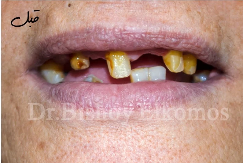 Front teeth before fixed crowns