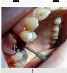 First stage of a dental implant