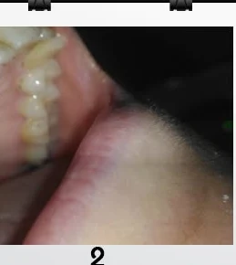 Second stage of a dental implant