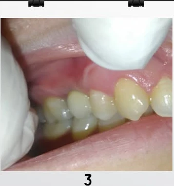 Third stage of a dental implant