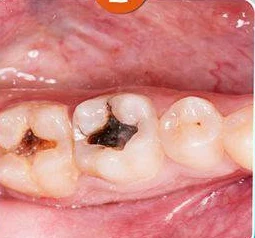 Tooth before composite filling