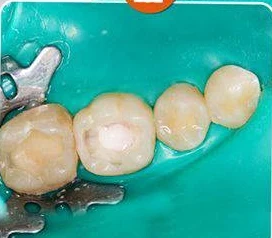 During composite filling preparation