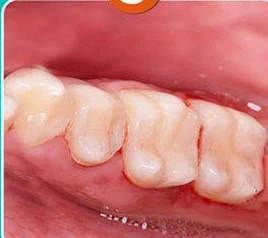 Tooth after completing the composite filling