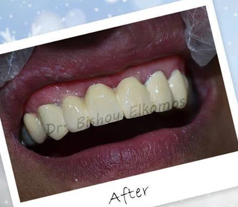 Front teeth after fixed crowns