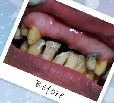 Front teeth before fixed crowns