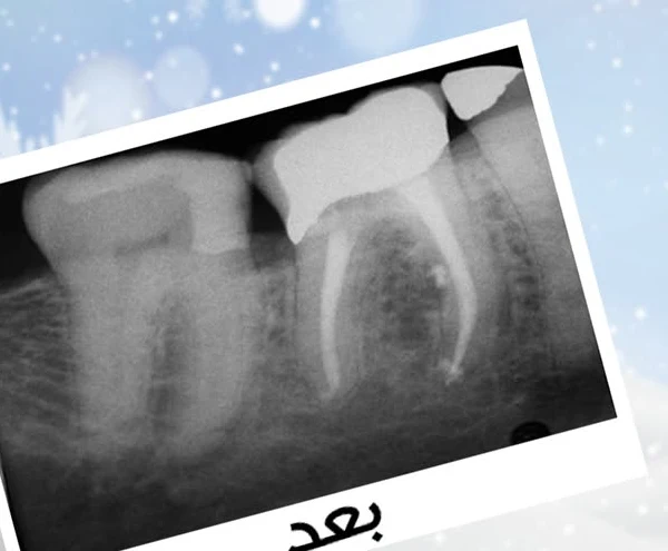 Molar X-ray after root canal treatment