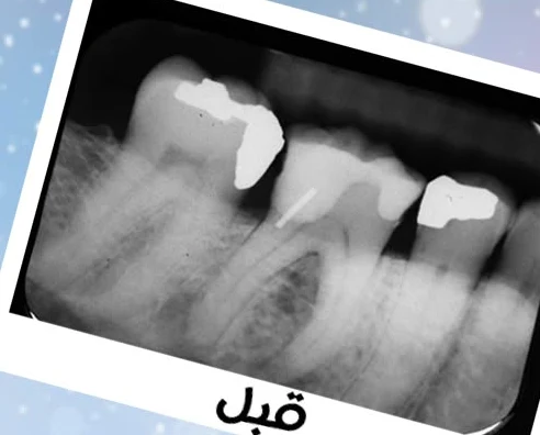 Molar X-ray before root canal treatment